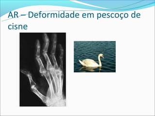 AR – Deformidade em pescoço de
cisne
 