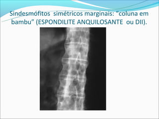 Sindesmófitos simétricos marginais: “coluna em
bambu” (ESPONDILITE ANQUILOSANTE ou DII).
 