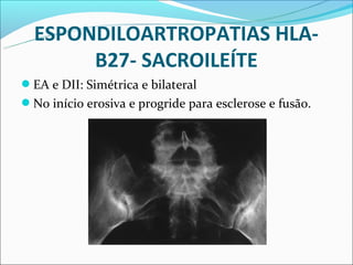 ESPONDILOARTROPATIAS HLA-
       B27- SACROILEÍTE
EA e DII: Simétrica e bilateral
No início erosiva e progride para esclerose e fusão.
 