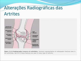 Alterações Radiográficas das
Artrites
 