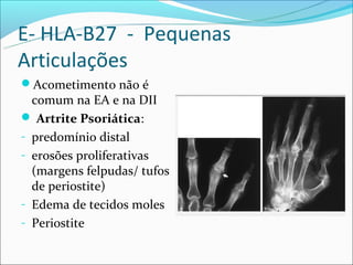 E- HLA-B27 - Pequenas
Articulações
Acometimento não é
  comum na EA e na DII
 Artrite Psoriática:
- predomínio distal
- erosões proliferativas
  (margens felpudas/ tufos
  de periostite)
- Edema de tecidos moles
- Periostite
 