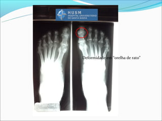 Deformidade em “orelha de rato”
 