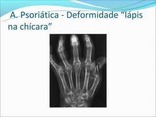 A. Psoriática - Deformidade “lápis
na chícara”
 