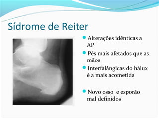 Sídrome de Reiter
               Alterações idênticas a
                AP
               Pés mais afetados que as
                mãos
               Interfalângicas do hálux
                é a mais acometida

               Novo osso e esporão
                mal definidos
 