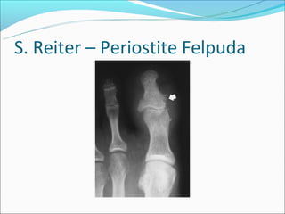 S. Reiter – Periostite Felpuda
 