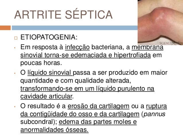 Artrite Séptica: O Que É, Sintomas, Diagnóstico E Tratamento – HTJRY