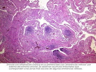 Sinovial con inflamación crónica en su primera fase con "eminencias vellosas" por
edema del estroma sinovial. Se observan acúmulos linfocitarios que
corresponden a las zonas más oscuras de algunas eminencias vellosas.

 