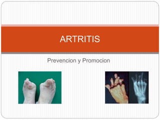 Prevencion y Promocion
ARTRITIS
 