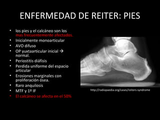 Periostitis Radiopaedia PRESENTACIÓN RADIOLÓGICA DE LAS ARTRITIS. | PPT