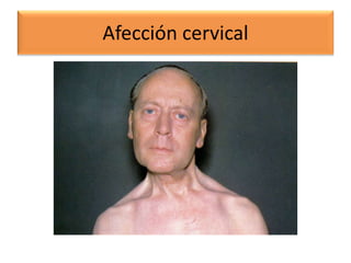 Afección cervical
 