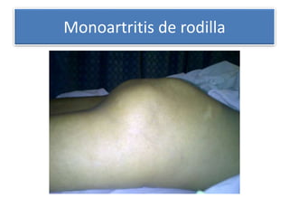 Monoartritis de rodilla
 