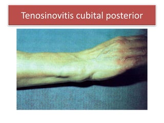 Tenosinovitis cubital posterior
 
