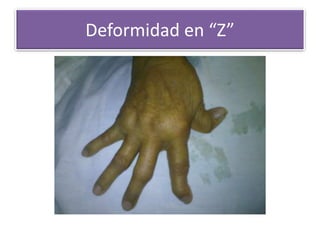 Deformidad en “Z”
 