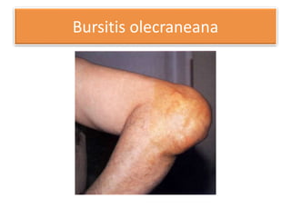 Bursitis olecraneana
 