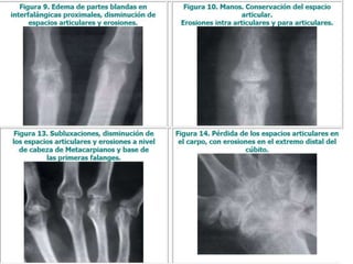 Dr.H.Martín - Artritis Reumatoide 56
 