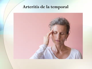 Arteritis de la temporal
• ♀ >50 años (80 a). Etiología desconocida.
• CEFALEA temporal o parietooccipital
• CLAUDICACION MANDIBULAR
Opresiva pulsatil y continua
↑ al presionar art. temporal
• AMAUROSIS
 