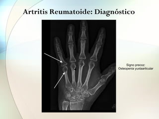 Artritis Reumatoide: Diagnóstico
Signo precoz:
Osteopenia yuxtaarticular
 