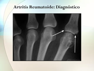 Artritis Reumatoide: Diagnóstico
FIGURA 2
Erosiones incipientes
© Fondo de Imagen de la Sociedad Española de Reumatología. Dr. Miguel A.
Belmonte.
FIGURA
Pinza
articu
© Fondo d
 