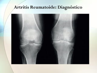 Artritis Reumatoide: Diagnóstico
A.
FIGURA 4
Pinzamiento homogéneo de la interlínea
articular
© Fondo de Imagen de la Sociedad Española de Reumatología.
 