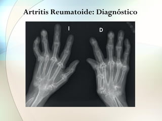Artritis Reumatoide: Diagnóstico
FIGURA 5
Luxaciones y deformidades características
© Fondo de Imagen de la Sociedad Española de Reumatología. Dra. Eva Álvarez.
D
I
Ana Cruz.
 