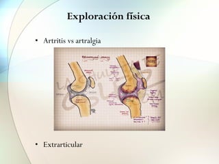 Exploración física
• Artritis vs artralgia
• Extrarticular
 