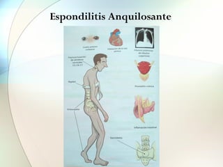 Espondilitis Anquilosante
 