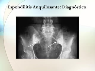 Espondilitis Anquilosante: Diagnóstico
los márgenes sacroilíacos (figura 7). 5. En las f
lógica e
sacroilí
6. A nivel
cuadrat
la erosi
como c
disco e
cuadrad
7. La imag
sindesm
vértebr
por osi
de los d
tar a la
8. En fase
imagen
9. La ente
terístic
FIGURA 7
Sacroileítis con esclerosis y erosiones
Obsérvese que la esclerosis afecta también al lado sacro de la
articulación.
© Fondo de Imagen de la Sociedad Española de Reumatología. Dr. Pau Lluis Lluch.
 