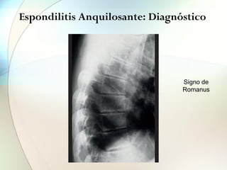 Espondilitis Anquilosante: Diagnóstico
José M. Bordas Julve Patrón inflamatorio
FIGURA 9
Cuadratura vertebral
Signo de Romanus.
FIGURA 10
Sindesmofitos
© Fondo de Imagen de la Sociedad Española de Reumato
Signo de
Romanus
 