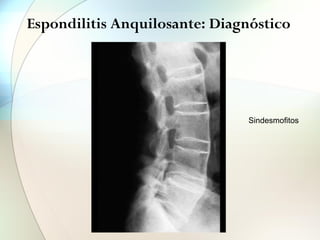 Espondilitis Anquilosante: Diagnóstico
Sindesmofitos
 