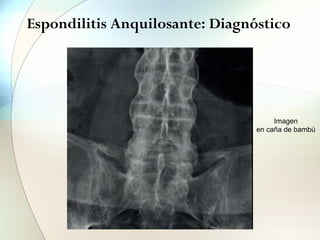 Espondilitis Anquilosante: Diagnóstico
FIGURA 13
Hiperostosis
idiopática (D
FIGURA 11
Columna en caña de bambú
Imagen
en caña de bambú
 