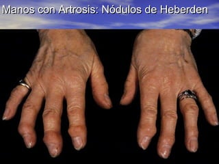 Manos con Artrosis: Nódulos de Heberden

 