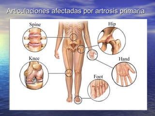 Articulaciones afectadas por artrosis primaria

 