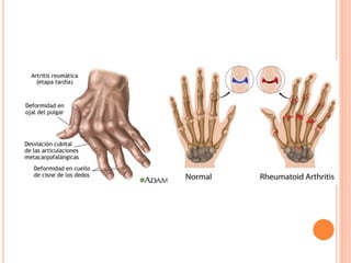 POSIBLES COMPLICACIONES
La artritis reumatoide puede afectar a casi cualquier parte del cuerpo. Las
complicaciones pueden ...