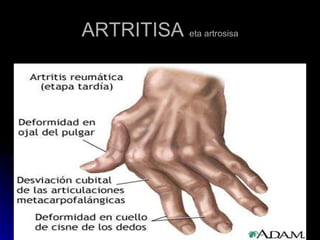 ARTRITISA  eta artrosisa 
