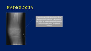 RADIOLOGÍA
Osteopenia con la ampliación de la
epífisis femoral distal. Crecimiento
excesivo de las epífisis se piensa que
es el resultado de la hiperemia
crónica
 