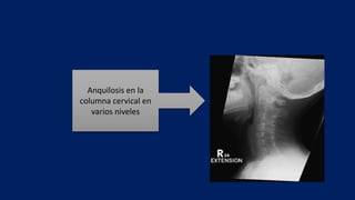 Anquilosis en la
columna cervical en
varios niveles
 