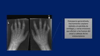 Osteopenia generalizada,
hacinamiento carpiano
(debido a la pérdida de
cartílago), y varias erosiones
que afectan a los huesos del
carpo y cabezas de los
metacarpianos
 
