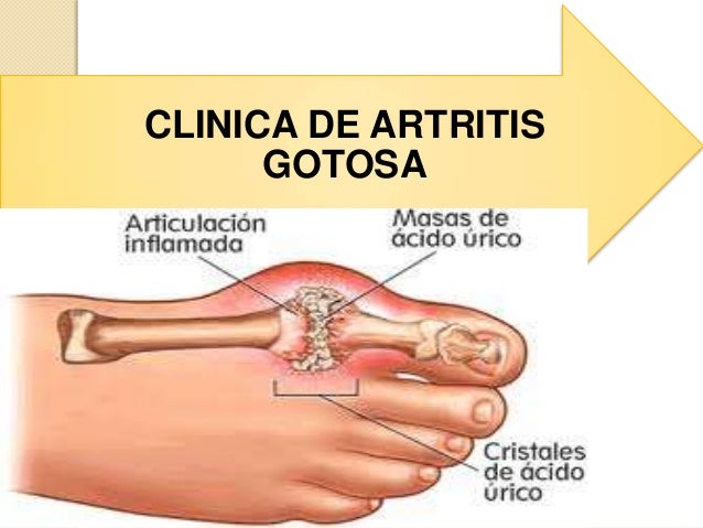 Resultado de imagen para artritis gotosa