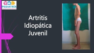 Artritis
Idiopática
Juvenil
 