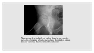 Placa simple de articulación de cadera derecha que muestra
aumento del espacio articular, aumento de densidad en tejidos
blandos y discreta desmineralización acetabular.
 