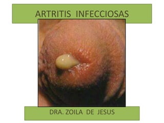 ARTRITIS INFECCIOSAS




   DRA. ZOILA DE JESUS
 