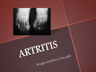 Artritis ppt