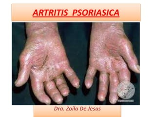ARTRITIS PSORIASICA




    Dra. Zoila De Jesus
 