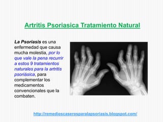 Artritis Psoriasica Tratamiento Natural
La Psoriasis es una
enfermedad que causa
mucha molestia, por lo
que vale la pena recurrir
a estos 9 tratamientos
naturales para la artritis
psoriásica, para
complementar los
medicamentos
convencionales que la
combaten.
http://remedioscaserosparalapsoriasis.blogspot.com/
 