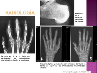 Erosiones típicas y mutilación con formación de "lápiz en
forma de copa" de las articulaciones interfalángicas
distales.
Dactilitis en 2º y 3º dedo con
particpacion de articulaciones
interfalángicas distales y proximales
Entensitis
en la
inserción
del tendón
de Aquiles
 
