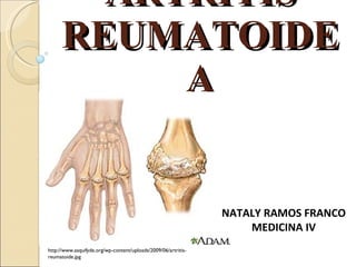 ARTRITIS REUMATOIDEA NATALY RAMOS FRANCO MEDICINA IV http://www.asquifyde.org/wp-content/uploads/2009/06/artritis-reumatoide.jpg 