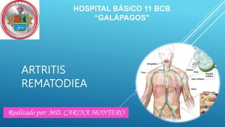 ARTRITIS
REMATODIEA
HOSPITAL BÁSICO 11 BCB
“GALÁPAGOS”
Realizado por: MD. CARINA MONTERO
 