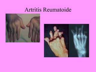 Artritis Reumatoide
 