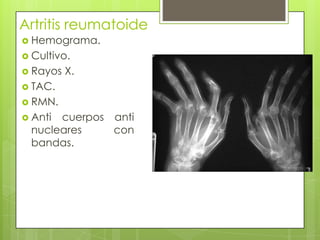 Artritis reumatoide Hemograma.Cultivo.Rayos X.TAC.RMN.Anti cuerpos anti nucleares con bandas.