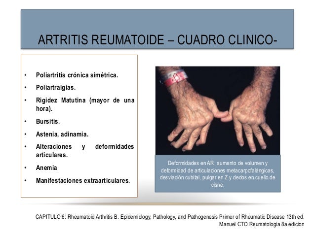 artritis reumatoide cuadro clinico artritis reumatoide artritis reumatoide cuadro clinico artritis reumatoide